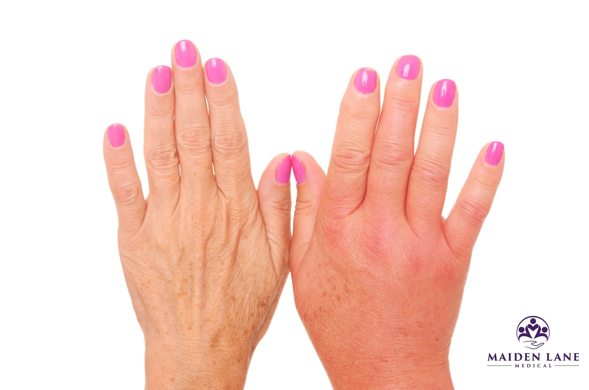 11 Ways to Reduce Swelling Maiden Lane Medical NYC