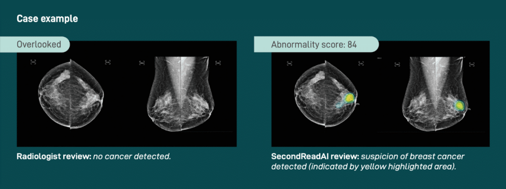 A case example of a radiologist review compared to a SecondReadAI review of suspicion of breast cancer detection.
